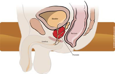 Prostate_Cancer