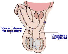 vasectomy