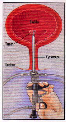 TRANSURETHRAL RESECTION OF BLADDER TUMOR (TURBT)